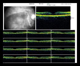 RADIAL LINE OD